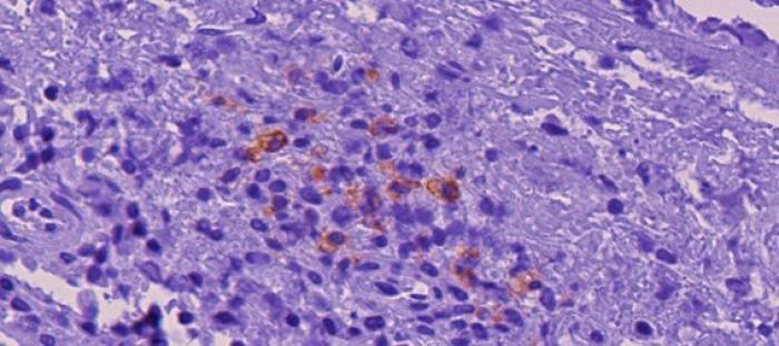 Figura 13. Inmunohistoquímica (+) al virus PIF de las preparaciones estudiadas. El marcaje positivo se encuentra en el interior de los macrófagos. (B) Médula, leptomeninge, imagen ampliada.