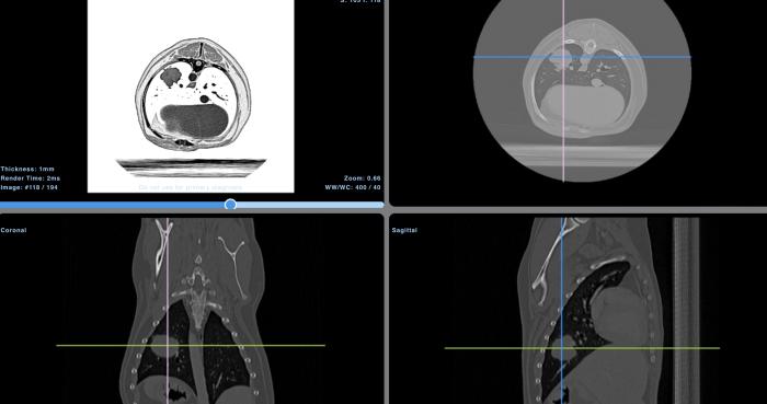 Figura 7. Pulmón masa pulmonar única de aproximadamente 2.58 cm de diámetro, contornos ligeramente irregulares localizada en el aspecto dorsal del lóbulo caudal izquierdo, dorsolateral al bronquio principal. La masa presenta un realce periférico, en anillo de dejado espesor y un centro con captación homogénea de contraste y algunas broncogramas aéreas. No se observan imágenes nodulares ni infiltrados parenquimatosos en el resto del parénquima pulmonar al momento del estudio.