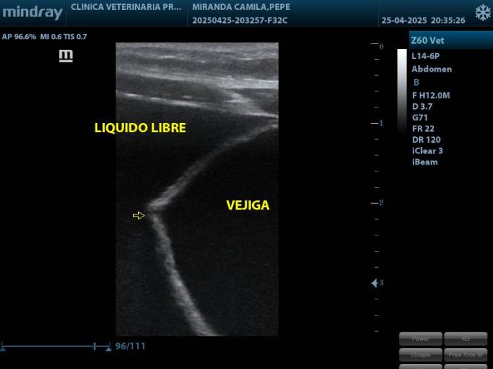 Figura 2. Se utiliza una sonda lineal de 12 MHz para obtener mayor detalle. La vejiga esta parcialmente distendida, en su pared en la zona del fundus se identifica una solución de continuidad de bordes irregulares, que sugiere ruptura vesical . Se evidencia también líquido libre abdominal.