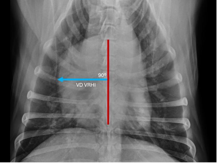 Representaci&oacute;n de la determinaci&oacute;n del &iacute;ndice card&iacute;aco vertebral derecho (VRHi) en proyecci&oacute;n ventro-dorsal (VD) en un perro parasitado por Dirofilaria immitis y que sufr&iacute;a de hipertensi&oacute;n pulmonar. Valor de 2,5 cuerpos vertebrales al trasladar la determinaci&oacute;n sobre las v&eacute;rtebras tor&aacute;cicas comenzando en el borde craneal de la cuarta v&eacute;rtebra tor&aacute;cica en proyecci&oacute;n latero-lateral derecha (l&iacute;nea de color azul).