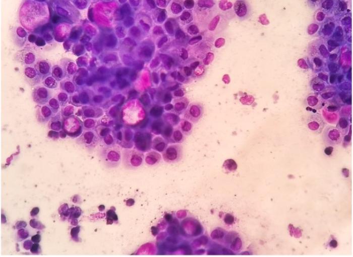 Se observa gran cantidad de células epiteliales pleomórficas, en ocasiones conteniendo un núcleo gigante. Las células presentan anisocitosis y anisocariosis marcadas, así como binucleación. Algunas células contienen inclusiones citoplasmáticas prominentes, compatibles con cuerpos de Melamed-Wolinska (aumento original 40x, Diff-Quick).