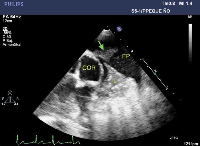 Figura 2. (A, B) Imágenes de la ecografía torácica mostrando efusión pleural (EP), restos de fibrina en pleura (fecha verde) o adheridos al epicardio (flecha roja). Se observa también el extremo de un lóbulo pulmonar atelectásico (L). El ECG en la imagen (B) muestra una salva de ritmo idioventricular acelerado y artefacto en cometa por la presencia de 2 proyectiles. COR, corazón; VI, ventrículo izquierdo.