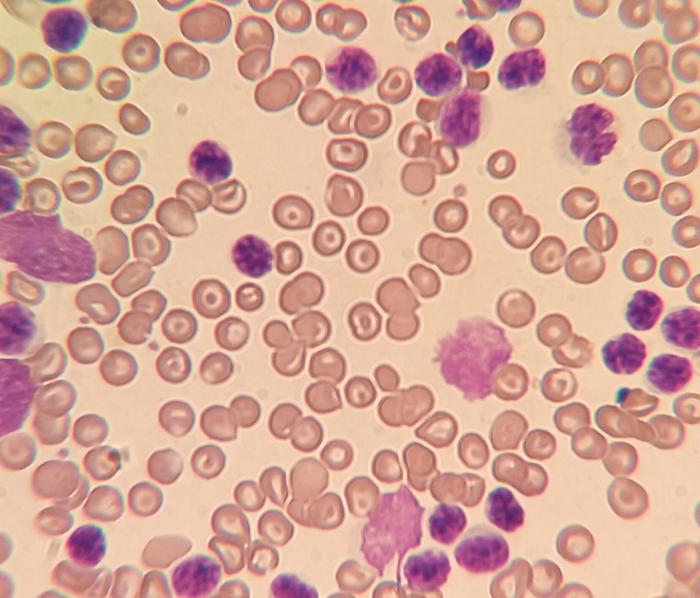 Figura 1. Frotis realizado en el hospital al obtener la lectura errónea de glóbulos blancos en la máquina de hematología. Dicho frotis revela la presencia de abundantes linfocitos atípicos.