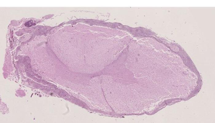 Figura 7. Médula espinal. Se observa un infiltrado inflamatorio en las leptomeninges.