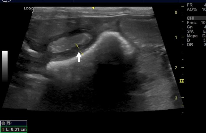 Figura 2. Imagen ecográfica de las paredes intestinales del paciente, observándose un grosor de (A) duodeno y (B) yeyuno por encima de lo normal (flechas blancas).