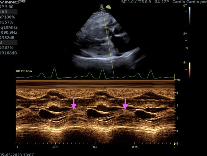 Figura 10. Ecocardiografía modo M en un gato con HCM. Proyección paraesternal derecha de eje corto a nivel de la válvula mitral. Se identifica la presencia de SAM, al apreciarse el velo anterior de la válvula mitral abierto durante la sístole (flechas rosas).