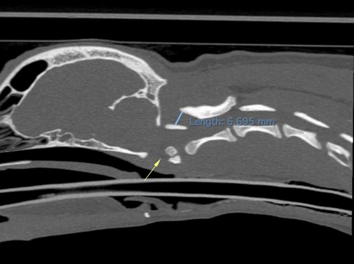 Figura 2. Imagen sagital de la zona cervical mediante TAC. La zona de subluxación aparece marcada con la flecha amarilla.