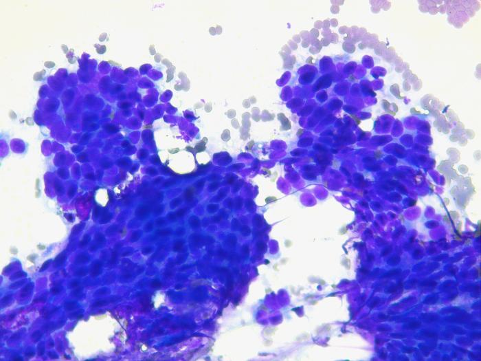 Figura 1. Citología de una lesion nodular pancreática en un gato compatible con carcinoma pancreático.