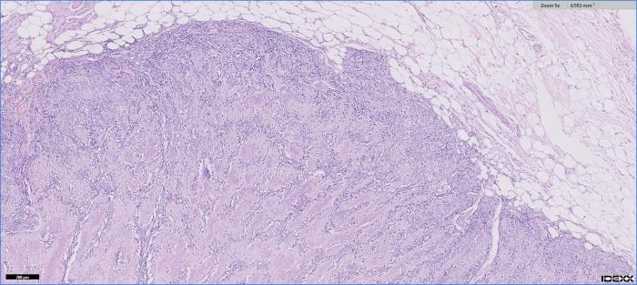 Figura 7. Confirmación histopatológica del diagnóstico de osteosarcoma. Sección de tejido subcutáneo y músculo esquelético en cuyo interior existe la expansión de una lesión nodular bien delimitada aunque de crecimiento periférico irregular que presenta un predominio de estructuras trabeculares organizadas en septos de tamaño variable que presentan frecuentes osteocitos uniformes delimitando espacios intertrabeculares que presentan zonas de incrementada densidad celular. Esta densificación celular se incrementa en la periferia de la lesión observándose la expansión de frecuentes osteoblastos productores de osteoide. Las células que componen estos grupos celulares varían de fusiforme a poliédricas y poseen un citoplasma eosinofílico a vacuolado e inconspicuo asociado a un núcleo redondeado de cromatina clara y nucleólo prominente. El índice mitótico es de 5/ 10 (x40) y la resección es completa. No existe conexión con estructuras óseas (imagen cortesía de Laboratorio IDEXX).