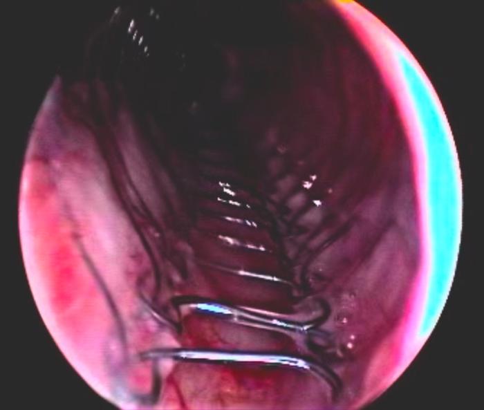 FIGURA 10. Vista endoscópica del stent metálico con recubrimiento para tratar un colapso traqueal.