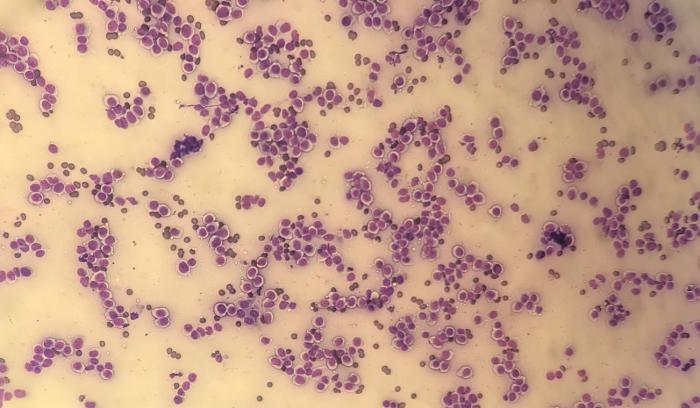 Figura 6. Citología por punción con aguja fina de un nódulo neoplásico de células redondas (histiocitoma).