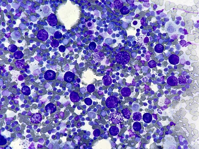 Figura 4. Citología del nódulo linfático poplíteo, aumentado en tamaño. Paciente diagnosticado de un mastocitoma digital bien diferenciado citológicamente. Metástasis de mastocitoma bien diferenciado (imagen cortesía de T-cito).