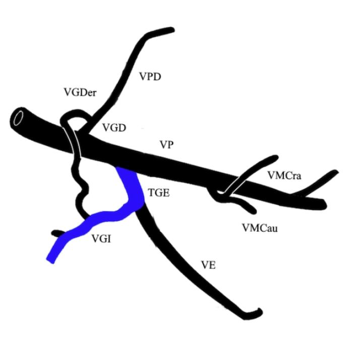 Figura 2. Sitios más frecuentes de origen de shunts. (A) Origen en la vena gástrica izquierda (VGI). (B) Origen en la vena gástrica derecha (VGD)  y su comunicación fisiológica con la VGI. (C) Origen en la vena cólica izquierda, afluente de la vena mesentérica caudal (VMCau). Adaptado de Robert N. White (ver ref.)15.  