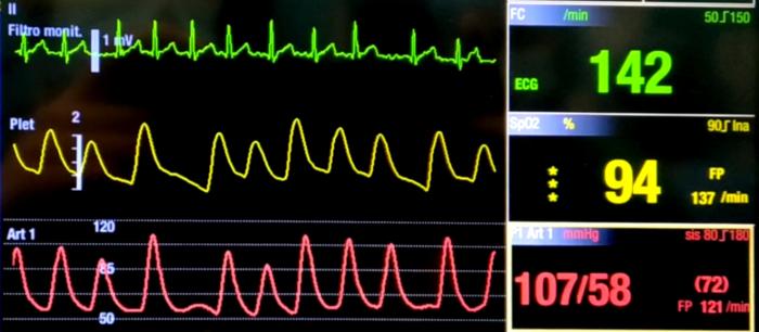 Figura 3. Monitorización hemodinámica del paciente durante el segundo procedimiento anestésico. De arriba abajo, electrocardiograma (verde), pletismografía (amarillo) y presión arterial invasiva (rojo). En el electrocardiograma, se observa la presencia de ondas f y ritmo ventricular irregularmente irregular. Tanto en la pletismografía y presión arterial se observa la diferencia de amplitud de pulso y presión, respectivamente, entre latidos.