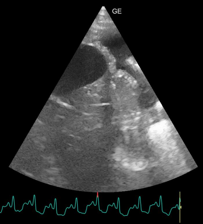 Figura 9. Presencia de derrame pleural durante la ecografía pulmonar.