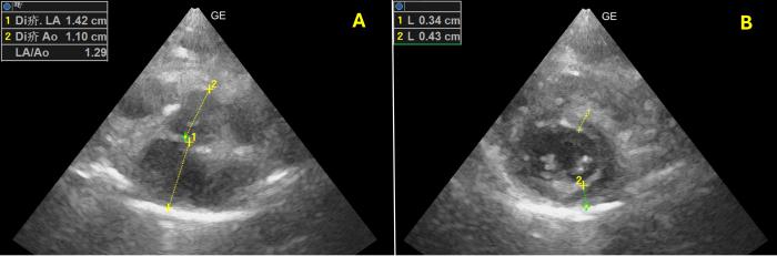 Figura 10. Ecocardiografía bidimensional. Corte paraesternal derecho en eje corto optimizado para la (A) aurícula izquierda y para el (B) ventrículo izquierdo. Normalización de las dimensiones tanto de la ratio Ai:Ao como del grosor del ventrículo izquierdo en telediástole.