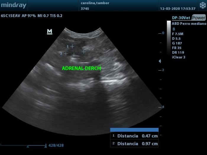 Figura 2. Imagen ecográfica de la adrenal derecha. 