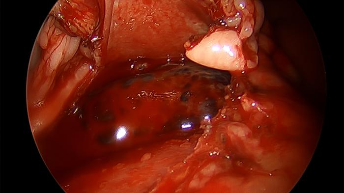 Figura 6. Imagen intraoperatoria durante la realización de la pericardiectomía e inicio de la pericardioscopia, donde se puede observar la región ventral de la masa cardiaca.