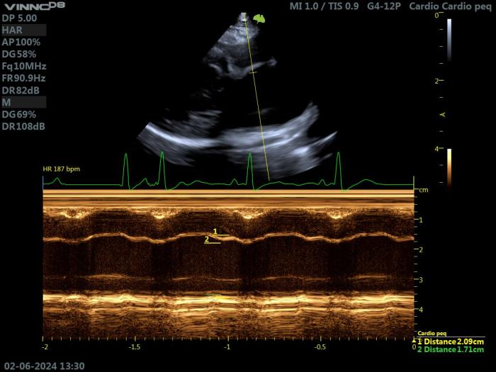 Figura 14. Ecocardiografía 2D en un gato con HCM. Proyección paraesternal derecha de eje largo 4 cámaras. Valoración de la fracción de acortamiento de la AI. LAmaxsyst 20.9 mm, LAmaxdiast17.1 mm. LASF = 18.18 %, que indica disfunción importante de la AI.