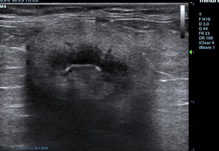 Figura 1. Disminución del tamaño renal, ausencia de diferenciación corticomedular y pelvis dilatada en un gato con pielonefritis crónica.