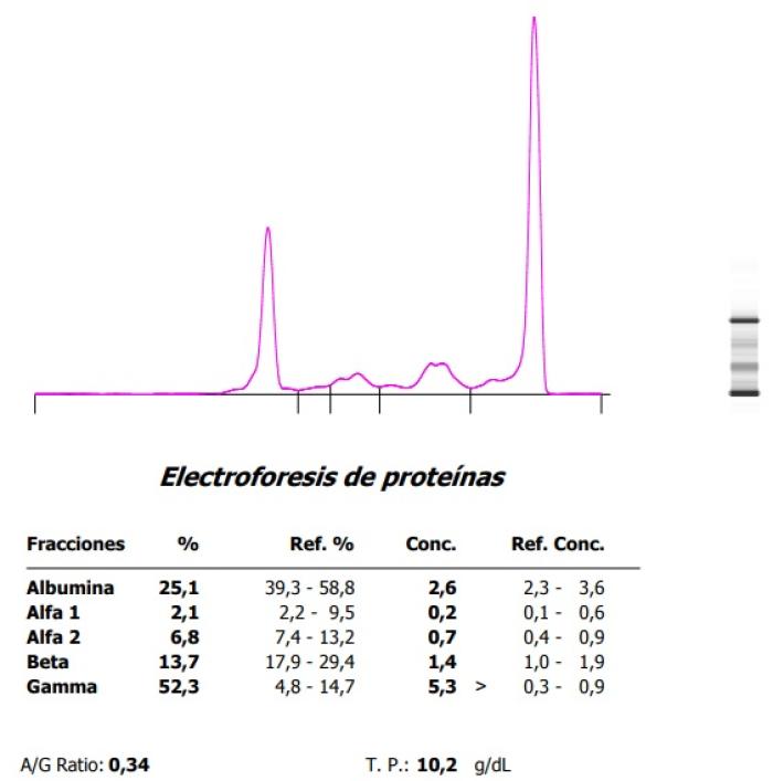 Figura 6. Hipergammaglobulinemia monoclonal en un hurón con (A) plasmocitoma esplénico y (B) evolución posesplenectomía.