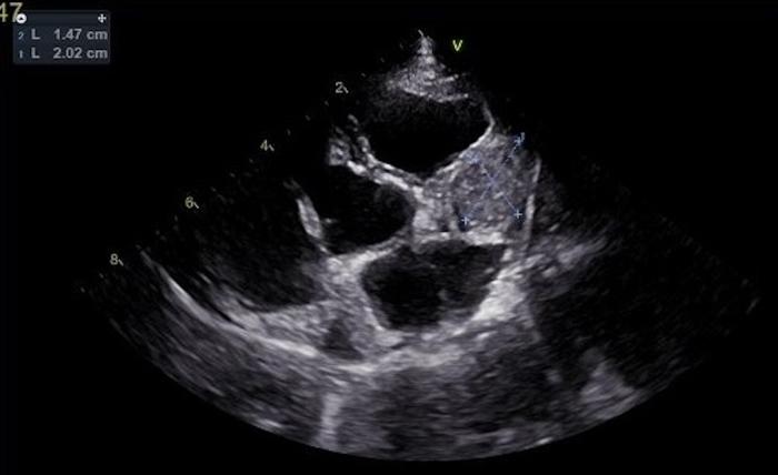 Figura 6. Ecocardiografía realizada dos semanas después de la esplenectomía. Se detectó una masa adherida a la aurícula derecha.