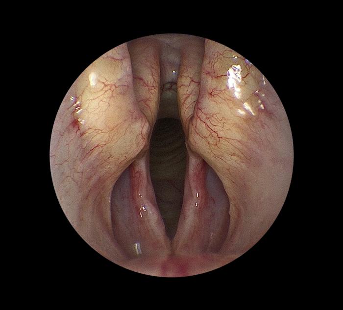 Figura 2. Imagen endoscópica de la laringe canina sana. 