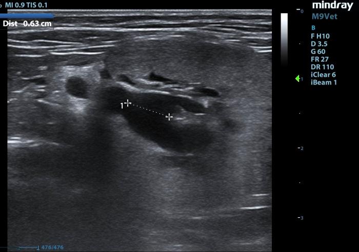 Figura 5. (A) Dilatación pelvis renal por obstrucción ureteral en corte transversal. Se observa el ureter proximal dilatado. (B) Dilatación de pelvis renal por obstrucción ureteral en corte longitudinal. (C) Ureterolito (flecha verde) localizado en uréter medio (flecha amarilla).