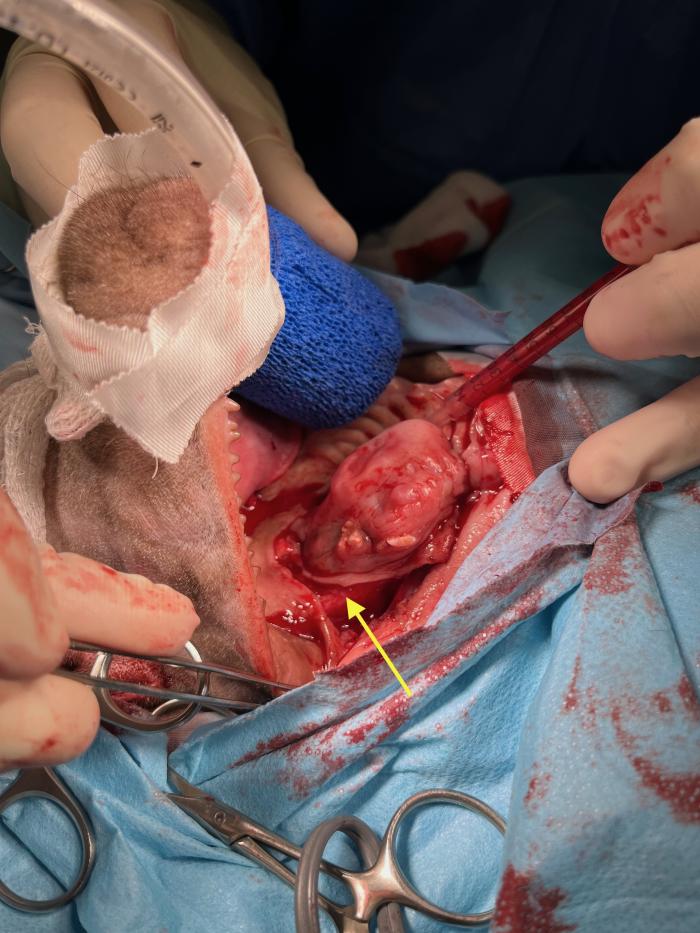 Figura 5. (A) Imagen intraoperatoria. Resección de los tejidos blandos alrededor de la masa tomando 1.5 cm de márgenes laterales en el mucoperiostio del paladar duro y 2 cm en la mucosa labial. La flecha amarilla indica la posición del hueso maxilar subyacente tras retraer la mucosa labial. Se empleó una aguja de 1 mls como punta de succión para la aspiración durante la cirugía. (B) Imagen intraoperatoria. Resección de los tejidos blandos alrededor de la masa tomando 1.5 cm de márgenes laterales en el mucoperiostio del paladar duro y 2 cm en la mucosa labial. El mosquito curvo se está empleando para realizar disección roma y ayudar a la separación de la mucosa labial del hueso. Se empleó una aguja de 1 mls como punta de succión para la aspiración durante la cirugía. (C) Imagen intraoperatoria. Resección de los tejidos blandos alrededor de la masa tomando 1.5 cm de márgenes laterales en el mucoperiostio del paladar duro y 2 cm en la mucosa labial. El elevador de periostio se ha empleado para separar el mucoperiostio del paladar duro del hueso subyacente. Se empleó una aguja de 1 mls como punta de succión para la aspiración durante la cirugía.