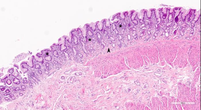 Figura 3. Estudio histopatológico del estómago en el que se observa la lámina propia superficial la cual se observa (A) leve hipercelularidad con un infiltrado mayoritariamente linfoplasmocitario (*), así como leve fibroplasia (cabeza de flecha), y (B) algunos linfocitos maduros pequeños, células plasmáticas y, ocasionalmente, neutrófilos viables.