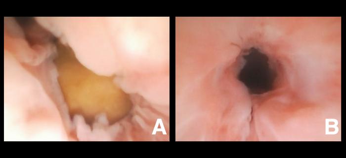 Figura 3. Uretritis proliferativa secundaria a (A) urolito impactado , responsable de (B) la disminución del diámetro uretral.