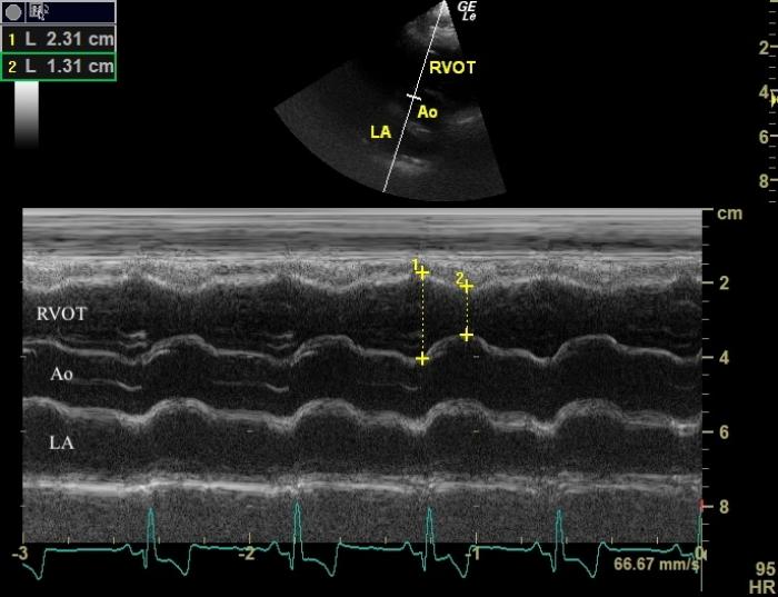 Figura 5. Se describe la medida de RVOT-FS en base a la fórmula: (RVOTd - RVOTs / RVOTd) x 100. 1: RVOTd; 2: RVOTs.