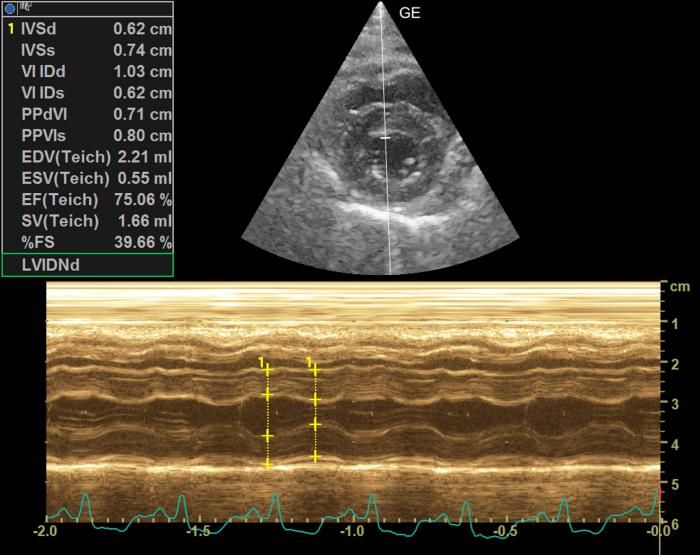 Figura 7. Modo M del corte transversal del ventriculo izquierdo. Medidas diastólicas del grosor de la pared del ventrículo izquierdo.  Incremento tanto de la pared libre como la septal (RR < 6 mm).