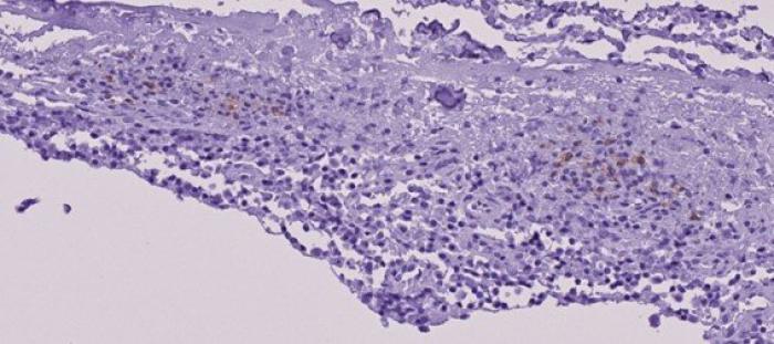 Figura 12. Inmunohistoquímica (+) al virus PIF de las preparaciones estudiadas. (B) Médula, leptomeninge.