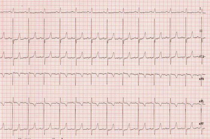 Figura 6. Electrocardiograma de 6 derivaciones, obtenido en decúbito lateral derecho tres días después de iniciar el tratamiento, mostrando un ritmo sinusal a 156 lat/min de frecuencia cardíaca. 50 mm/s, 1 cm = 1 mV.