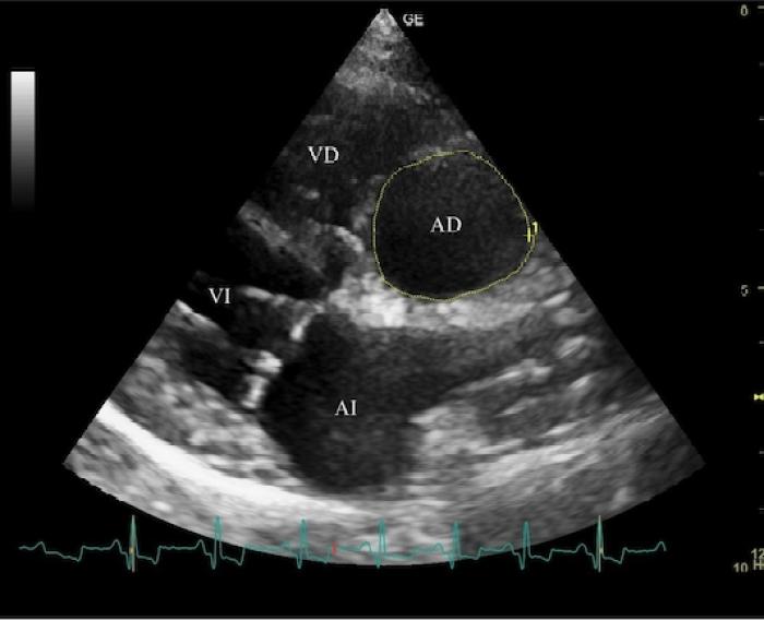 Figura 2. (A) Corte longitudinal cuatro cámaras optimizando AD. (B) Corte paraesternal apical izquierdo de cuatro cámaras.