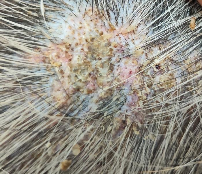 Figura 3. Fotografía de lesión macroscópica con alopecia, pápulo-costras amarillas gruesas con comedones.