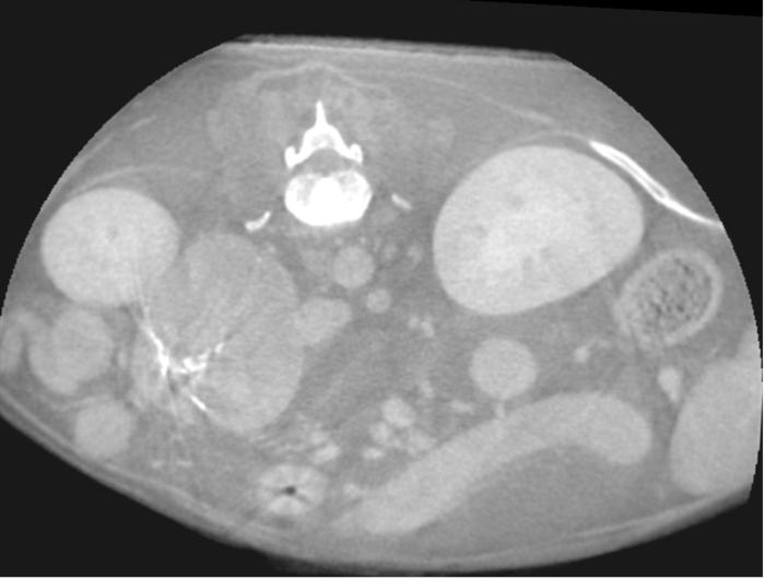 Figura 1. Masa adrenal derecha. Nótese la dimensión de la masa y la presencia de calcificaciones.