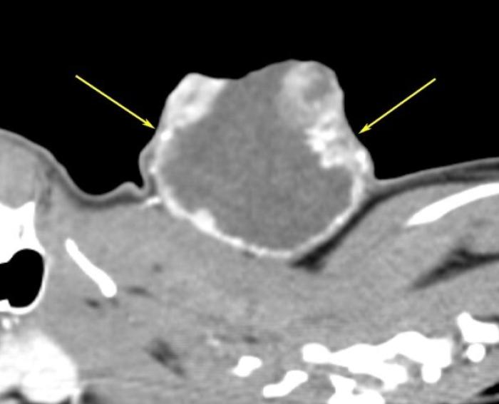 Figura 2. Imágenes de tomografía computarizada de la masa cervical: corte (A) transversal y (B) longitudinal. La masa se localiza en la parte dorsal del cuello, tiene marcado realce periférico (flechas amarillas) y se compone mayoritariamente de una parte cavitaria y una pequeña parte de tejido. En su aspecto ventral, a la altura de C3-C4 (parte media de la masa), por el lado derecho, se desdibuja la pared y los bordes de la masa se observan difusos afectando a los músculos ventrales (flecha azul) (imágenes cedidas por el servicio de diagnóstico por imagen del Hospital Clínico Veterinario CEU).