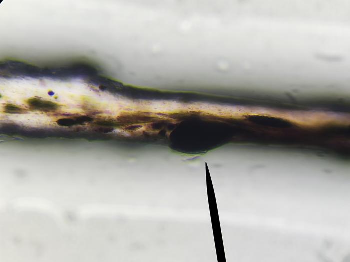 Figura 4 y 5. Fotografía del tricograma en la que se observa un macromelanosoma cortical (flecha negra). Asimismo, se aprecia una dilatación de la unión córtico-medular del tallo piloso, constituyendo una zona de fragilidad estructural predispuesta a la fractura del pelo.