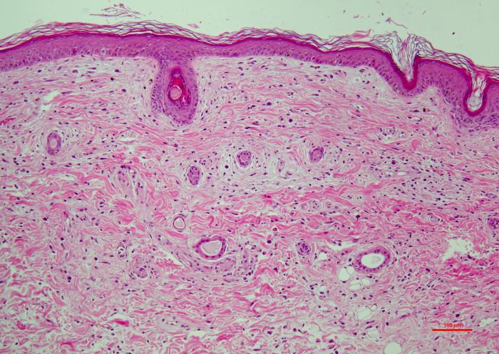 Figura 4. (A) Atrofia folicular severa (faded follicles). (B) Dermatitis de interfase pobre en células (degeneración hidrópica y apoptosis de las células basales de la epidermis, exocitosis linfocítica). (C) Vasculopatía afectando vasos superficiales (pared engrosada, hialinizada y con ausencia de endotelio vascular). (D) Porción profunda de la biopsia, se observan discretas infiltraciones linfocíticas en el perimisio (alrededor de las fibras musculares).