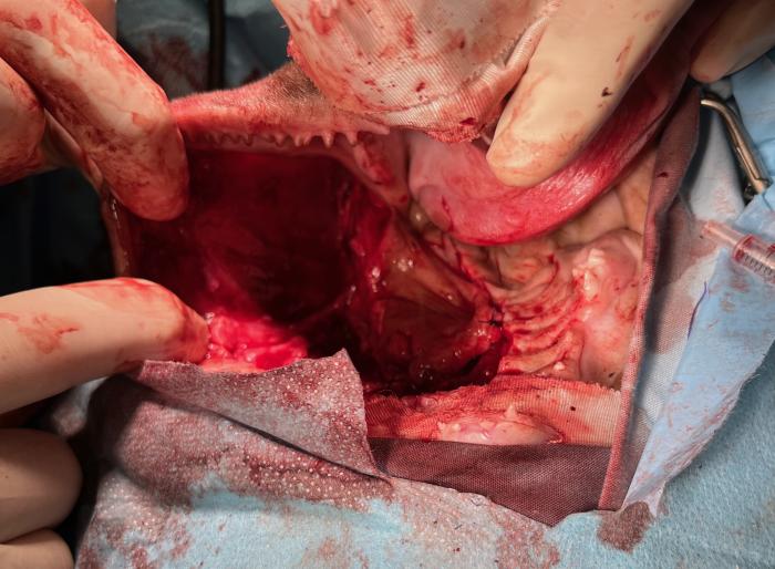 Figura 9. Imagen intraoperatoria. Una vez creado el colgajo labial basado en la arteria angular oral, se fijó por lateral a la mucosa gingival y a la mucosa labial con puntos simples.  