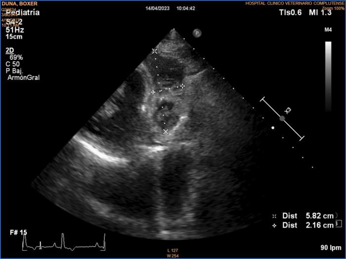 Figura 4. Ecocardiografía del momento del diagnóstico; corte longitudinal izquierdo de tres cámaras optimizado para ver tracto de entrada ventricular derecho. Se observa una masa que abarca pared libre atrial derecha y ventricular derecha, de ecogenicidad mixta con evidentes imágenes hipoecogénicas compatibles con vascularización en su interior, de 5.8 cm x 2.16 cm de dimensiones mínimas. Esta lesión es compatible con hemangiosarcoma.