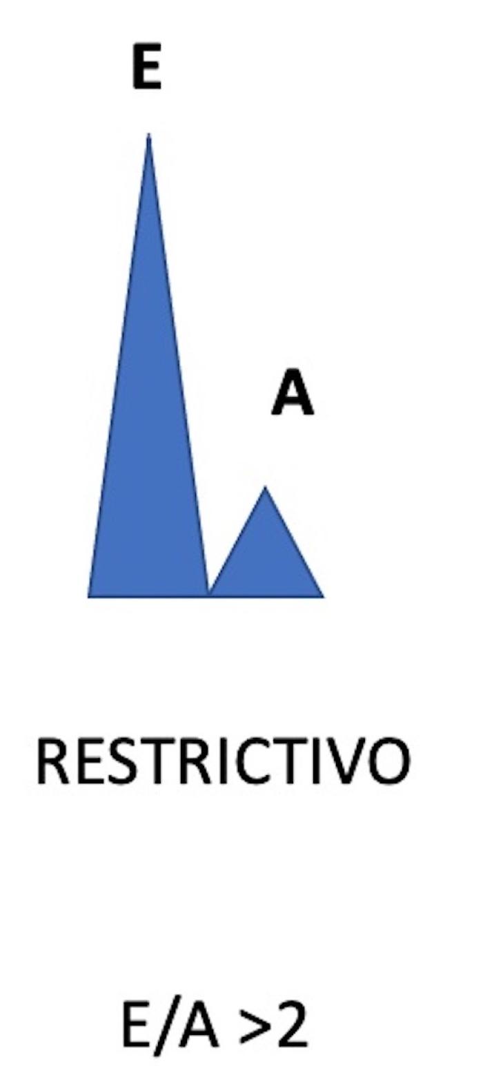 Figura 7. (A) Patrón restrictivo, onda E muy alta y onda A muy baja con ratio E/A>2. (B) Patrón restrictivo en un perro con EVMD en Fase C, onda E de elevada velocidad 2.3 m/s.