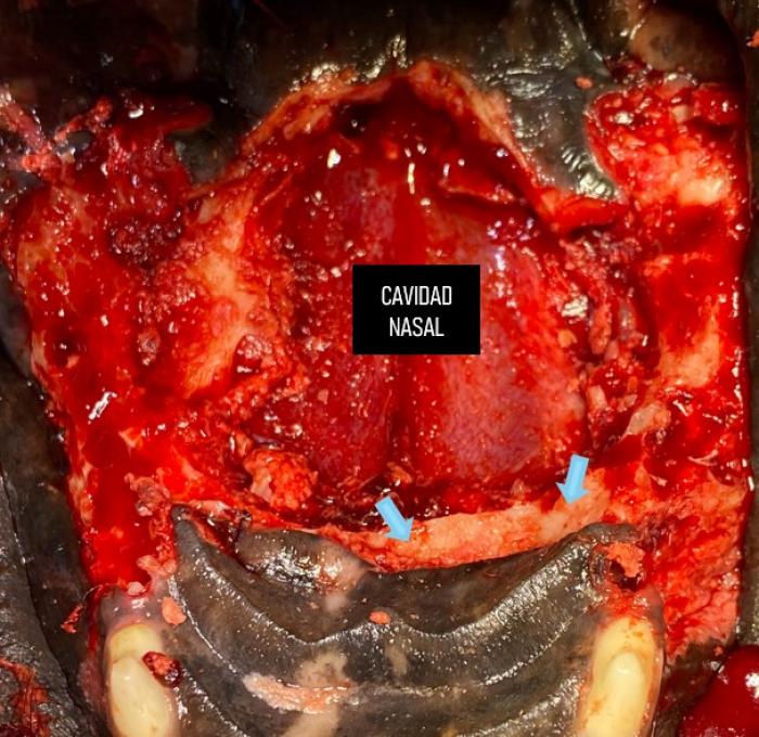 Figura 4. Luego de la resección de la neoplasia en bloque la cavidad nasal se comunica en forma directa con la cavidad oral. Se señala con flecha el escalón óseo necesario para que el colgajo labial tenga soporte a nivel de la línea de sutura.