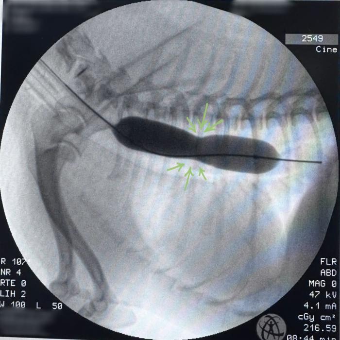 Figura 2. Imagen de fluoroscopia donde las flechas verdes indican la estenosis. En la imagen se ve como se realiza una dilatación con balón tradicional.