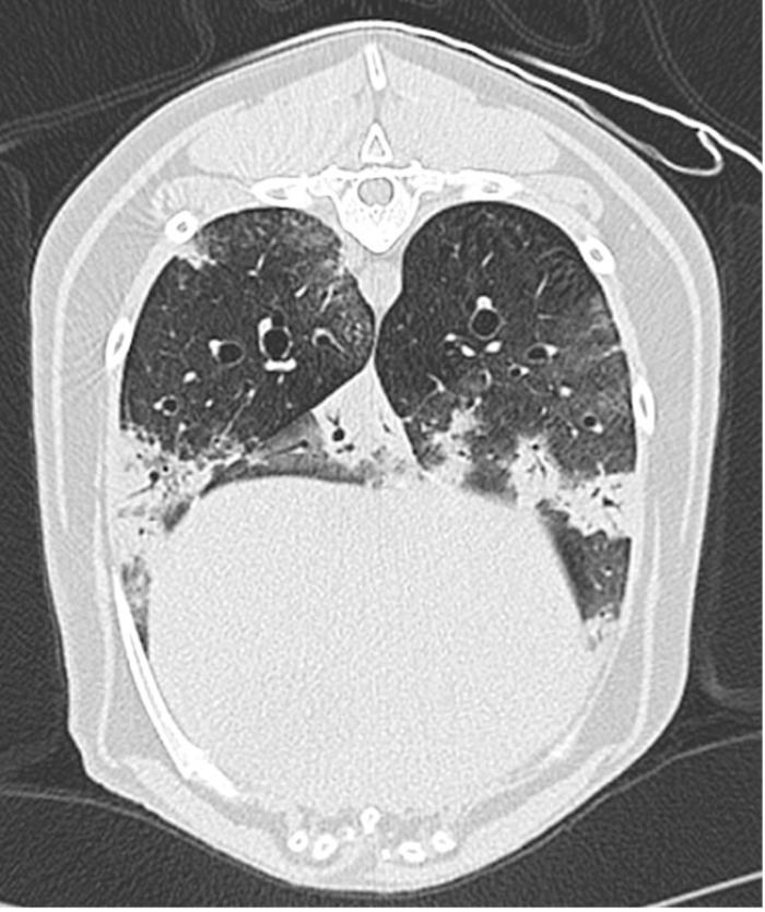 Figura 1A-B. Corte transversal en algoritmo de pulmón. Se muestran múltiples focos (flechas) de patrón alveolar situados en la periferia pulmonar y asimétricos.