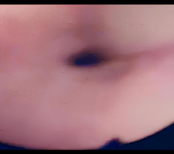 Figura 5. Estenosis esofágica cervical a 2-3 cm del esfínter esofágico craneal, obtenida por endoscopia flexible.