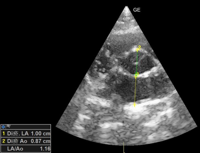 Figura 2. Corte paraesternal derecho en eje corto optimizado para valorar la ratio atrio izquierdo:aorta (Ai/Ao). No se aprecia dilatación del atrio izquierdo.