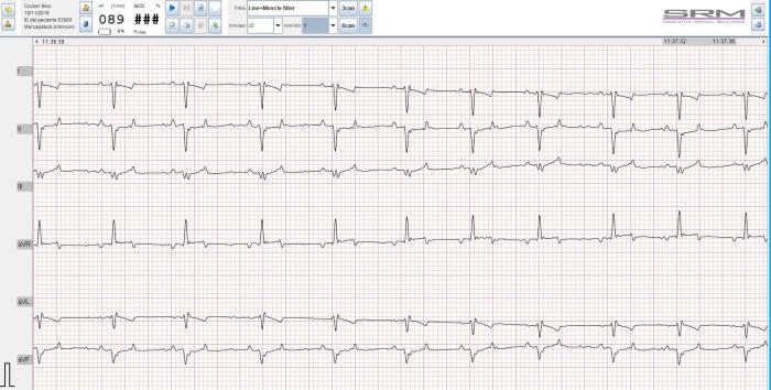 Figura 2. Electrocardiograma en el que se muestra desvío de eje cardíaco hacia derecha (patrón S1, S2, s3) compatible con bloqueo de rama derecha (ausencia de agrandamiento de ventrículo derecho en ecocardiografía ni radiografía torácica).